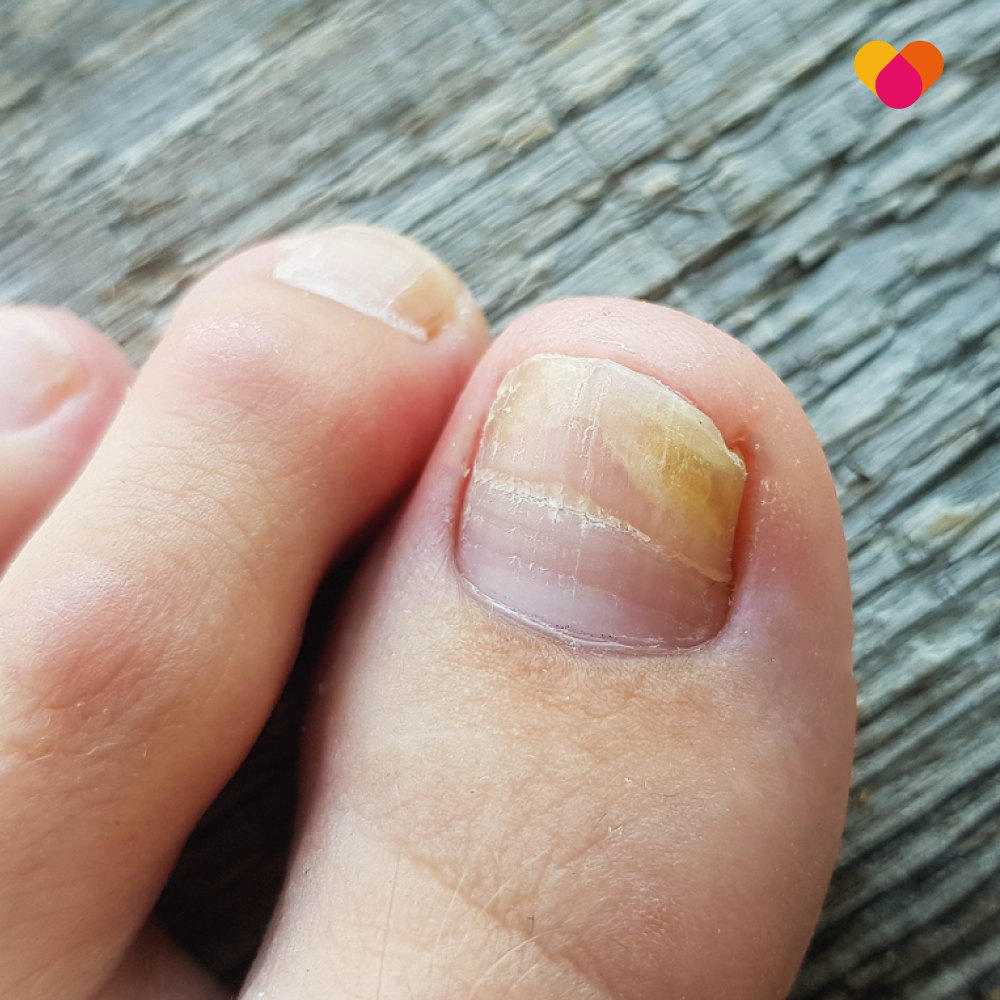 Close up of a toe with a fungal nail infection