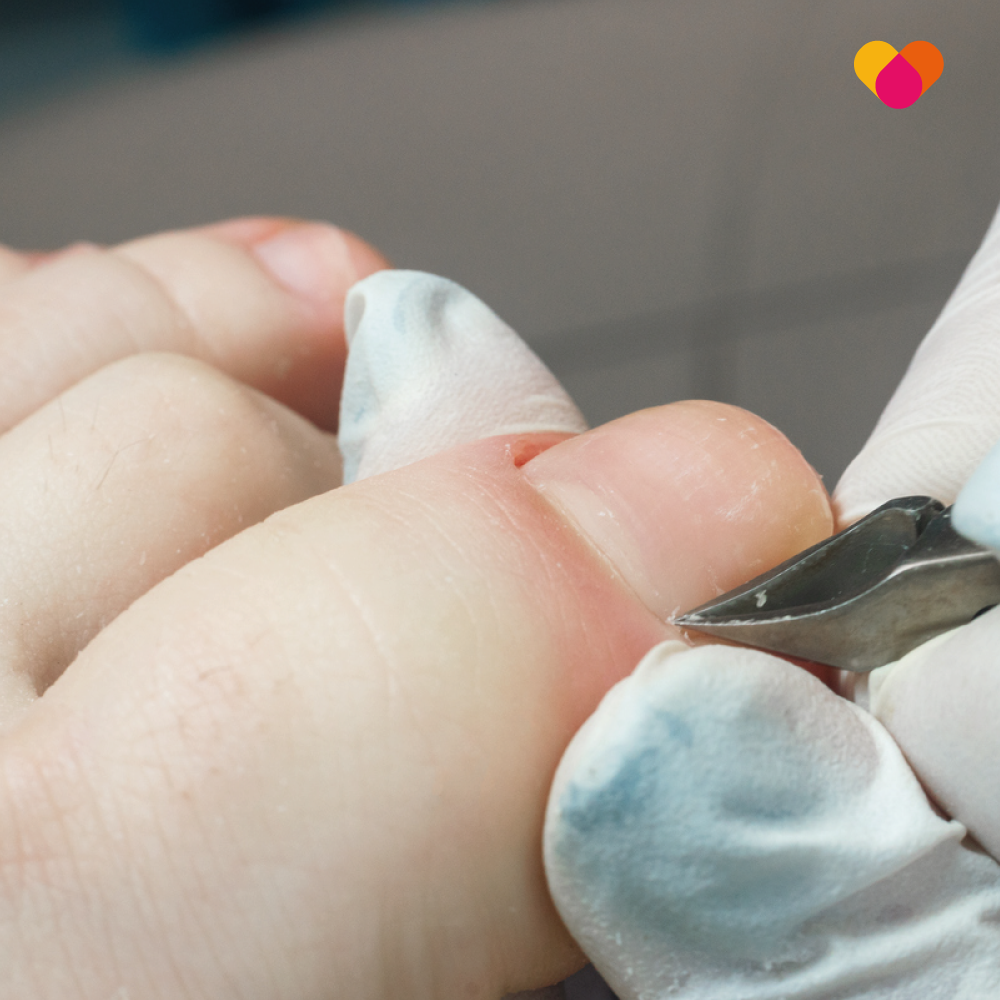 Ingrown toenail being treated by a podiatrist