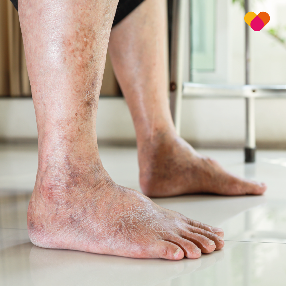 Person suffering with Peripheral Vascular Disease